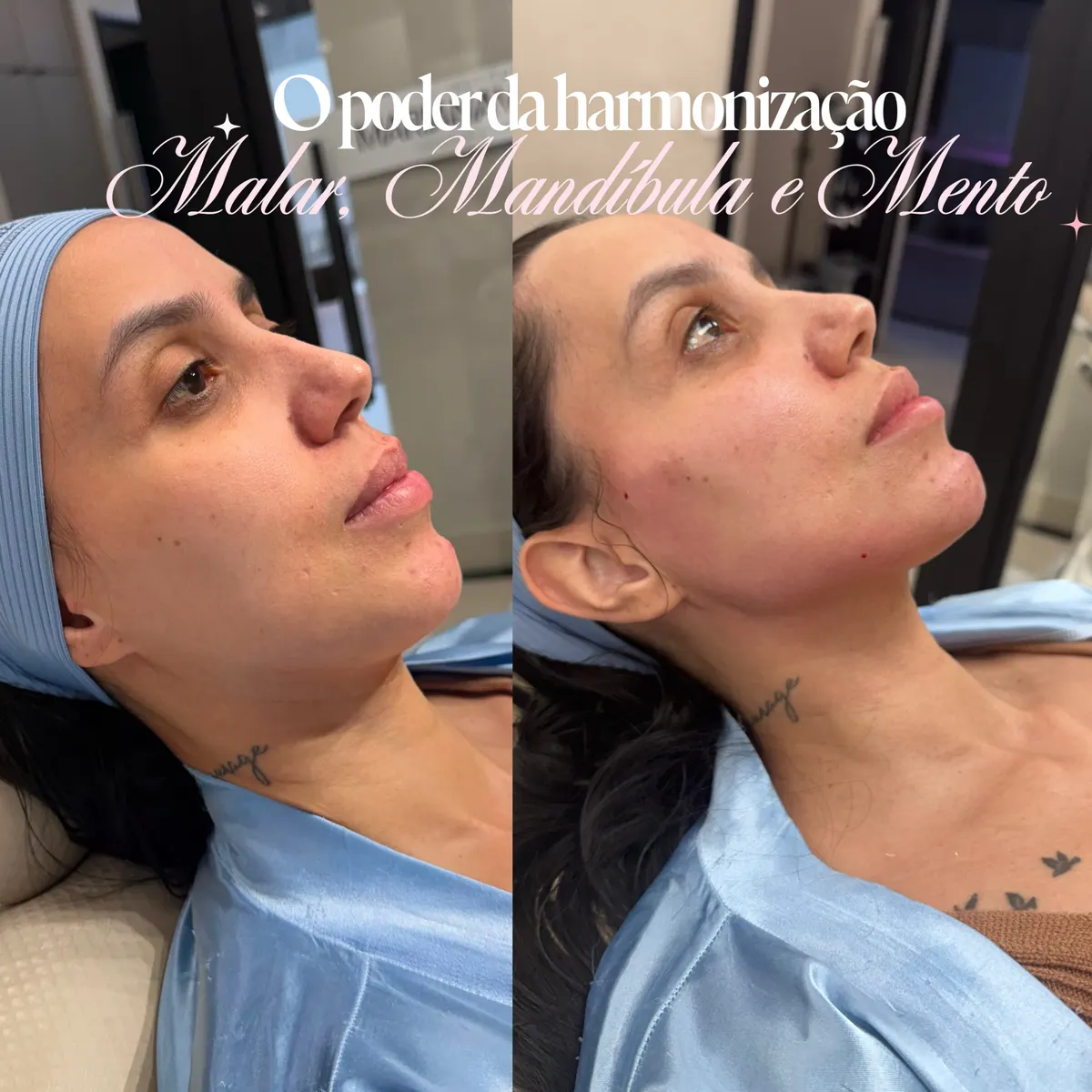 Antes e depois de harmonização de malar, mandíbula e mento